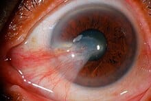 PTERYGIUM शस्त्रक्रिया